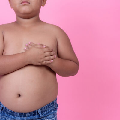 Todo cuidado é pouco, conheça quais os riscos que a obesidade infantil pode trazer.